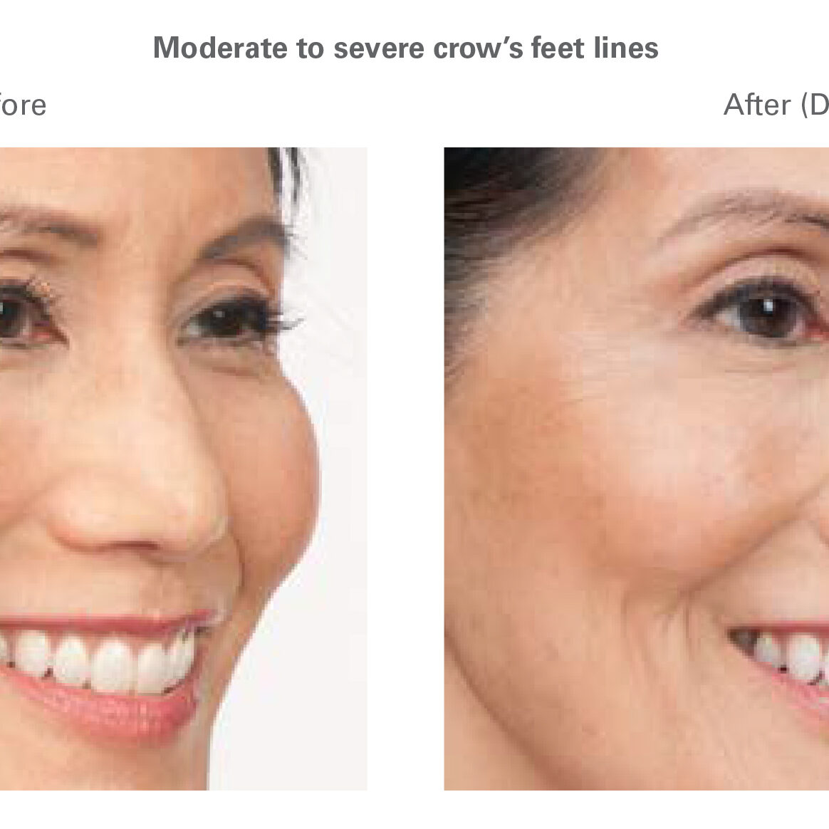 botox in north dallas