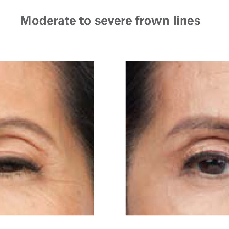 Botox for Crows Feet and Frown Lines