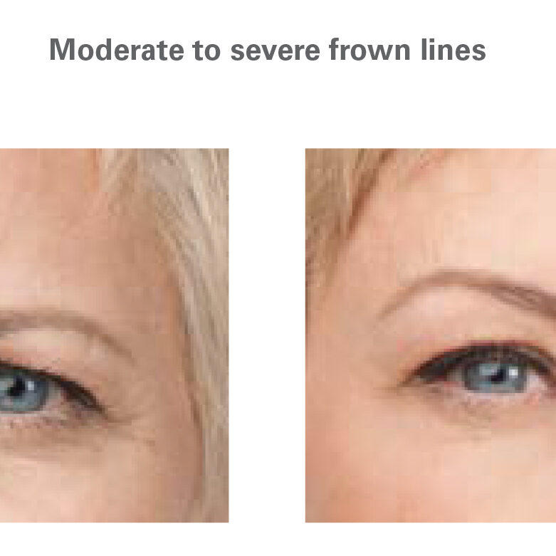 botox for crows feet in north dallas, tx