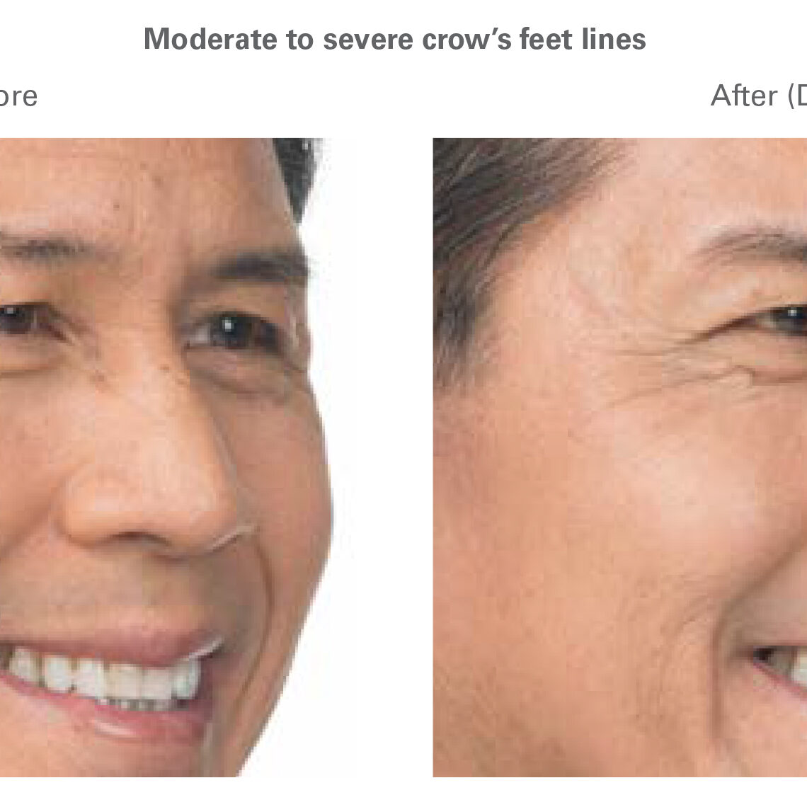 botox for men in north dallas, tx crows feet