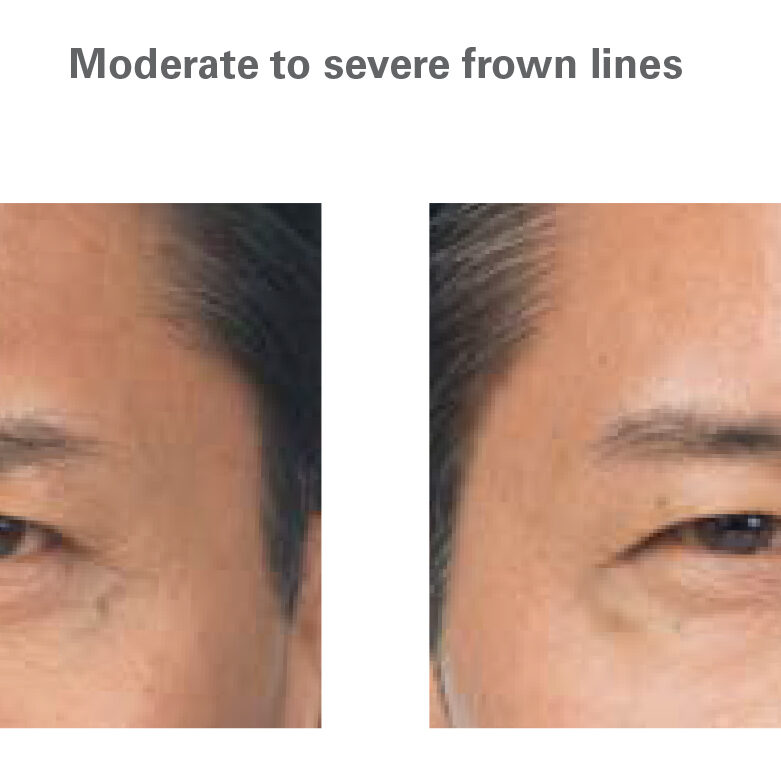 botox for men in north dallas, tx crows feet