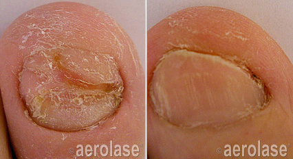 toe fungus treatment near me