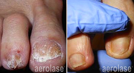 toe fungus treatment near me