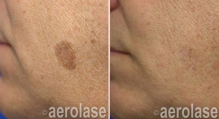 laser brown spot removal near me