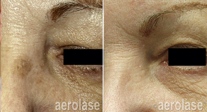 laser brown spot removal near me