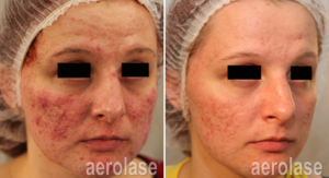 laser acne treatment in dallas