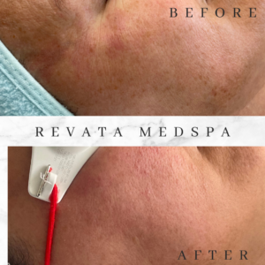 aerolase facial dallas