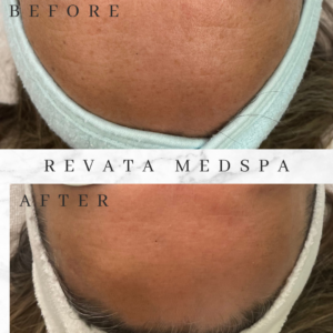 aerolase facial dallas