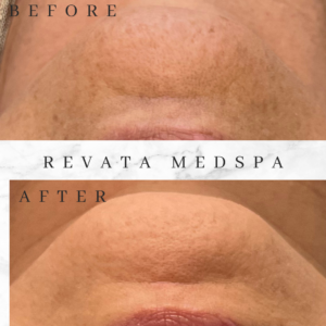aerolase facial dallas