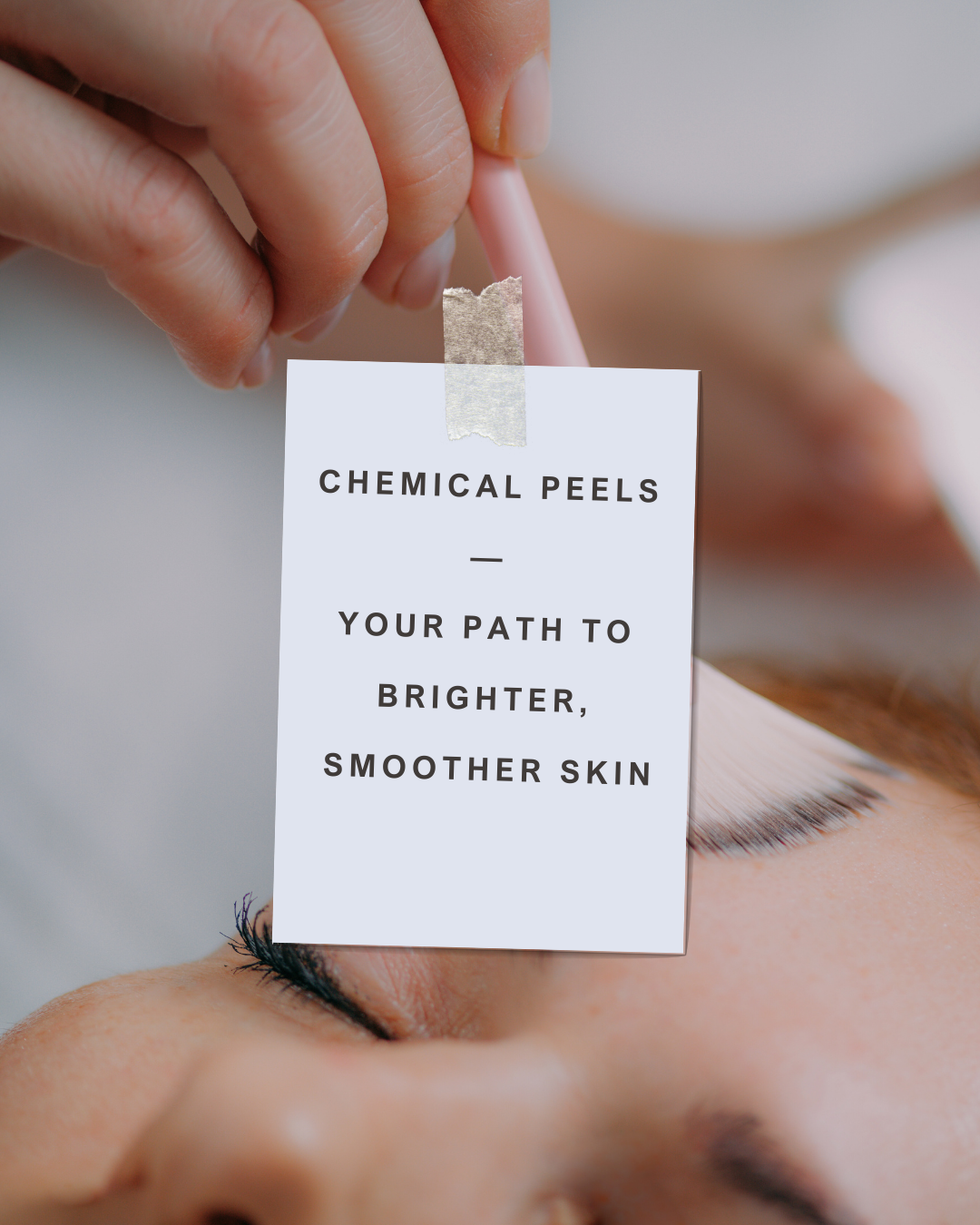 chemical peels